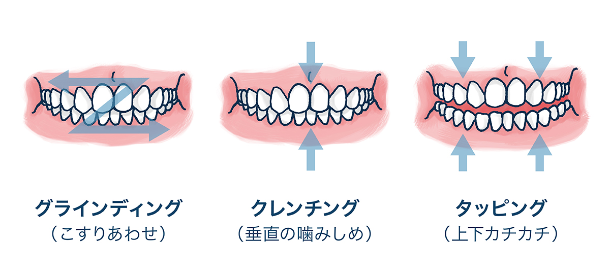 を 食いしばる 意味 歯 「自分を愛して！」歯のトラブル編