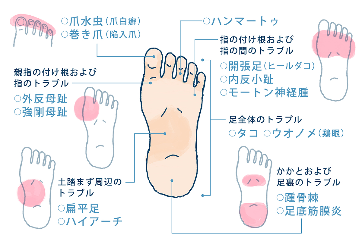 日本は足ケアの後進国 ポダイアトリー って知っていますか