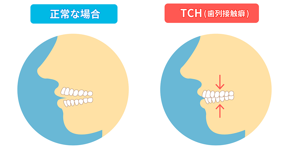 Tch 歯列接触癖 | 歯列接触癖 初期症状 : 歯列接触癖（THC）とは？原因や症状、対策を解説 – MFDZ